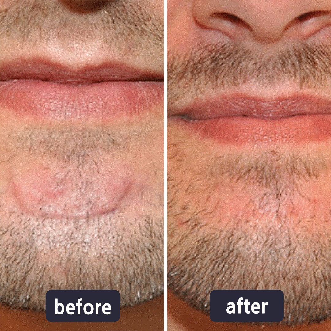 Bellevixa™ Scar Removal Gel