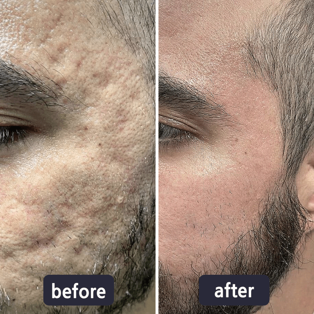 Bellevixa™ Scar Removal Gel