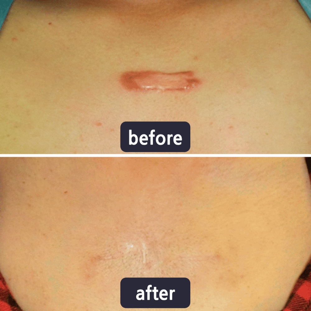 Bellevixa™ Scar Removal Gel
