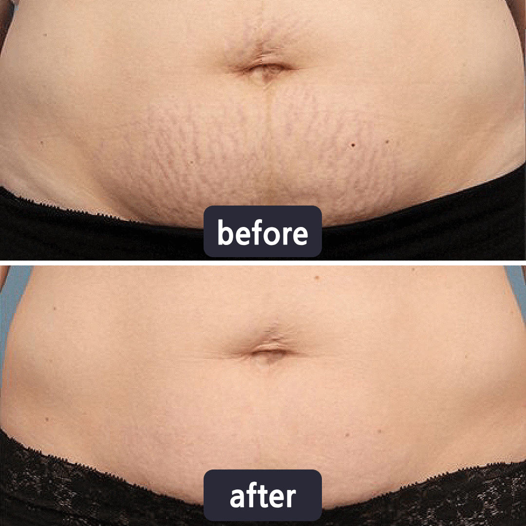 Bellevixa™ Scar Removal Gel