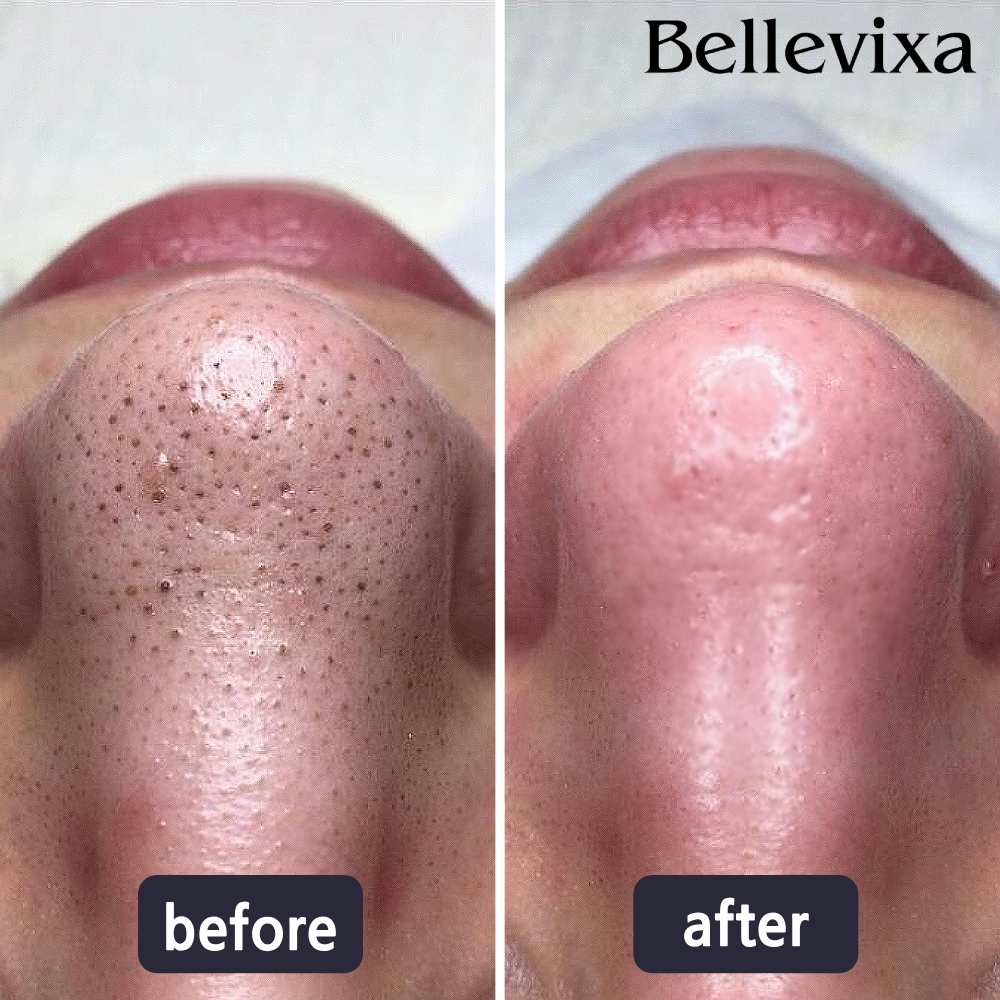 DermaVacuum™ - Pore Vacuum