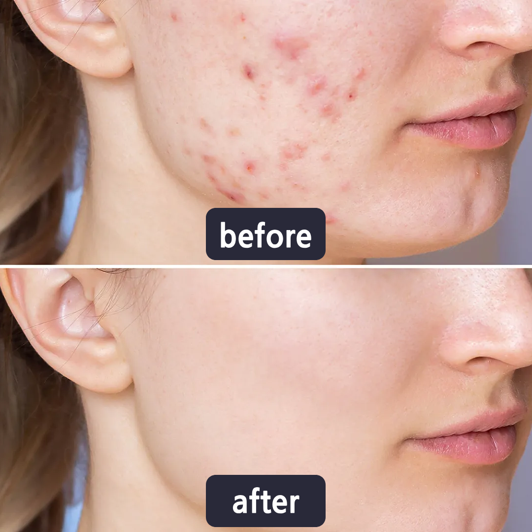 Microneedling Pimple Patches