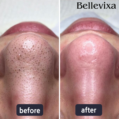 DermaVacuum™ - Pore Vacuum